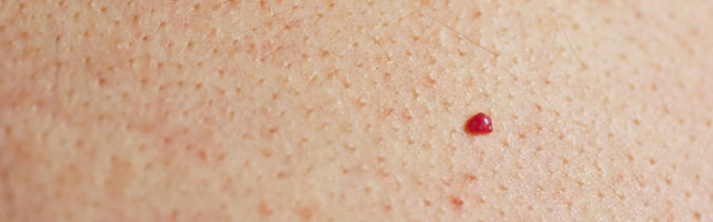 Красные родинки, или вишневые ангиомы, являются распространенными новообразованиями кожи, которые могут развиваться в большинстве областей вашего тела